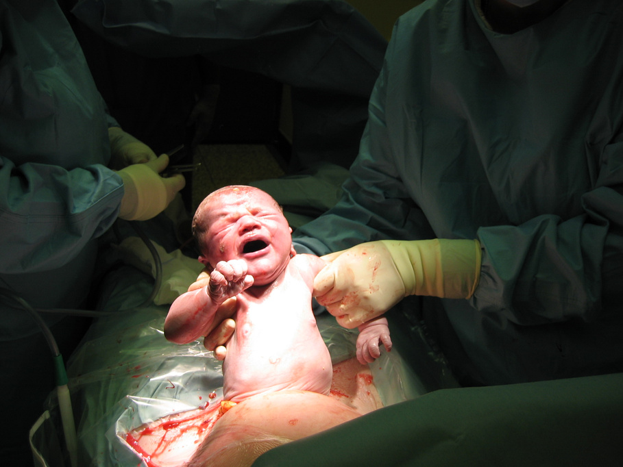 Caesarean